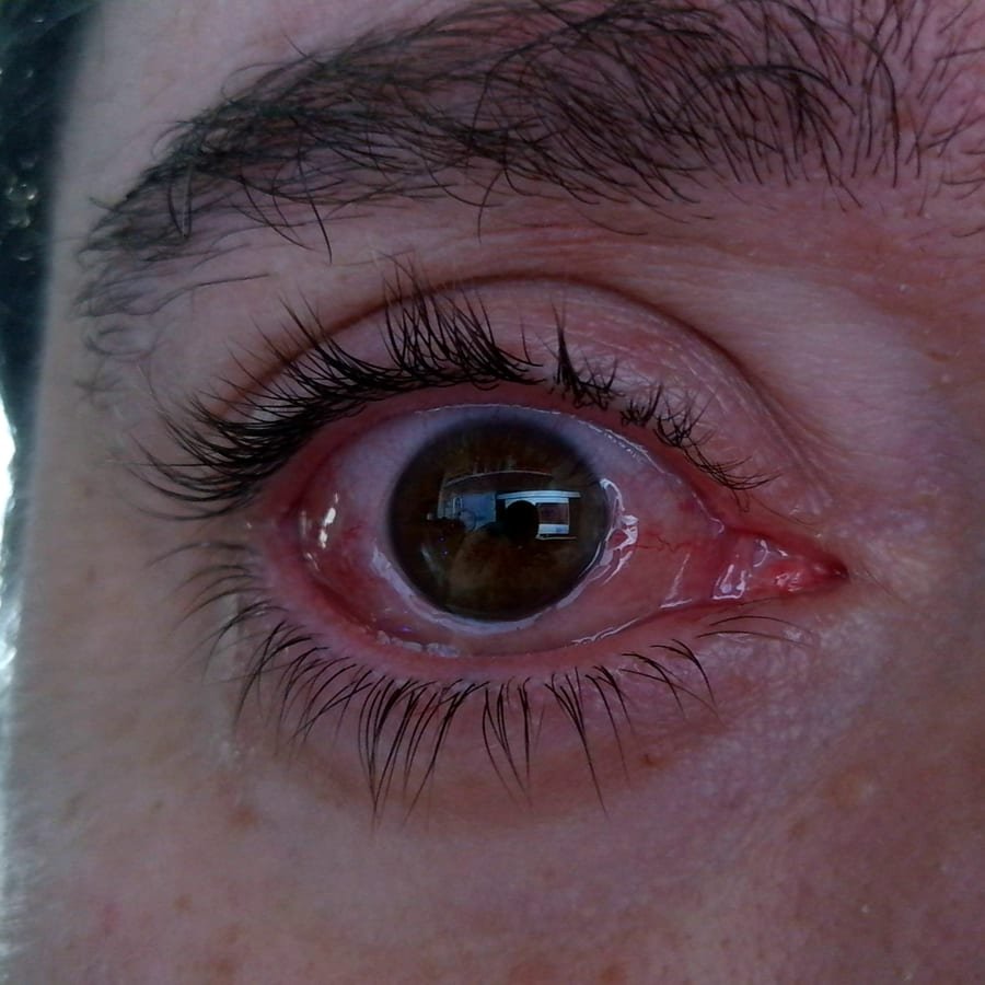 Ojo enrojecido e irritado, con la conjuntiva inflamada y lagrimeo.
