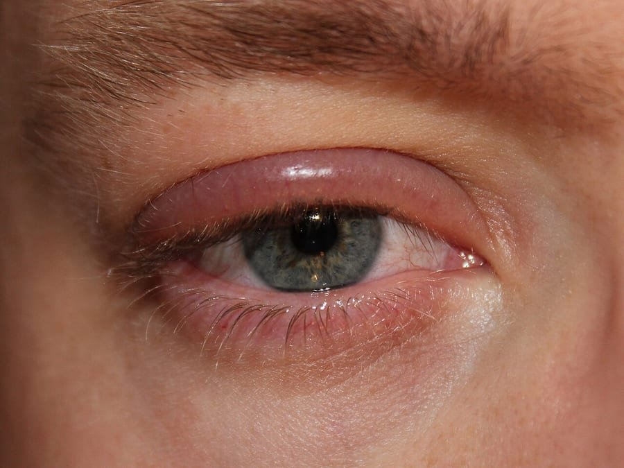 Ojo con el borde del párpado enrojecido e inflamado en la línea de las pestañas.