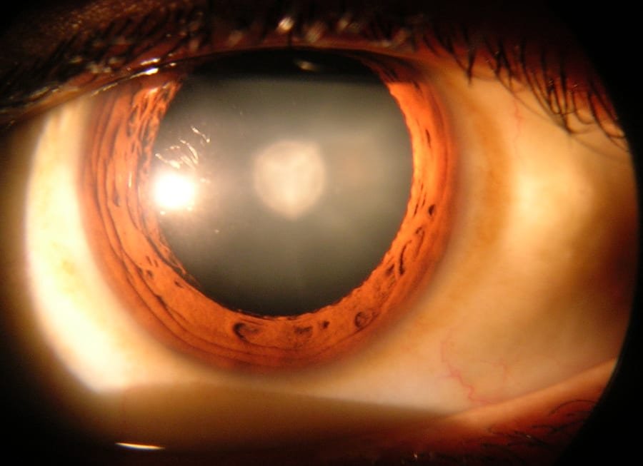 Primer plano de un ojo en el que el cristalino se ve blanquecino y opaco tras la pupila.