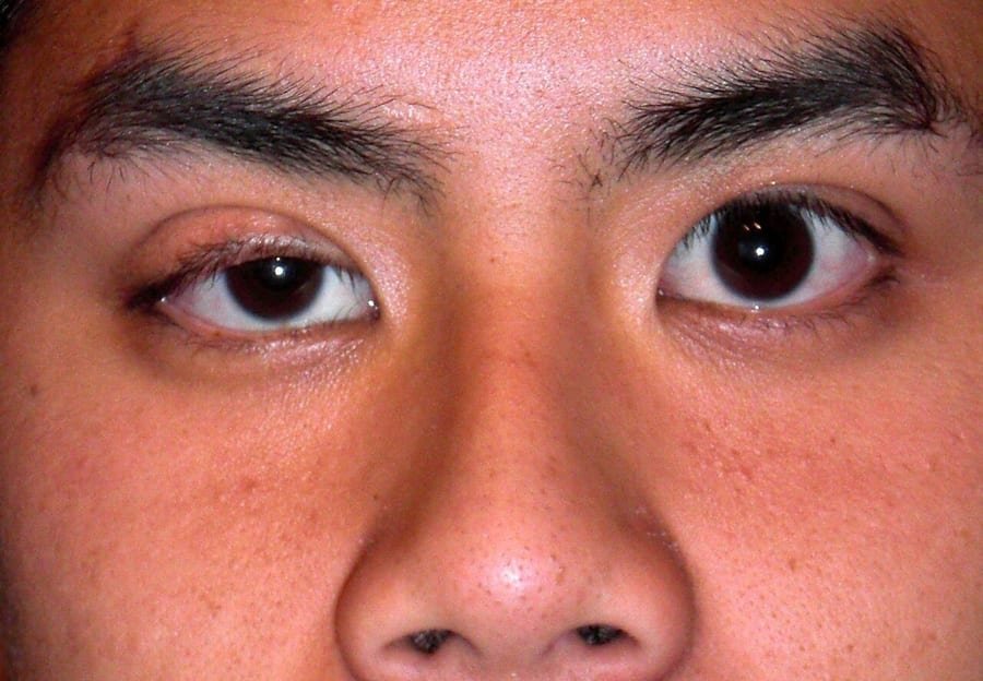 Rostro visto de frente con caída del párpado superior del ojo derecho respecto al izquierdo.